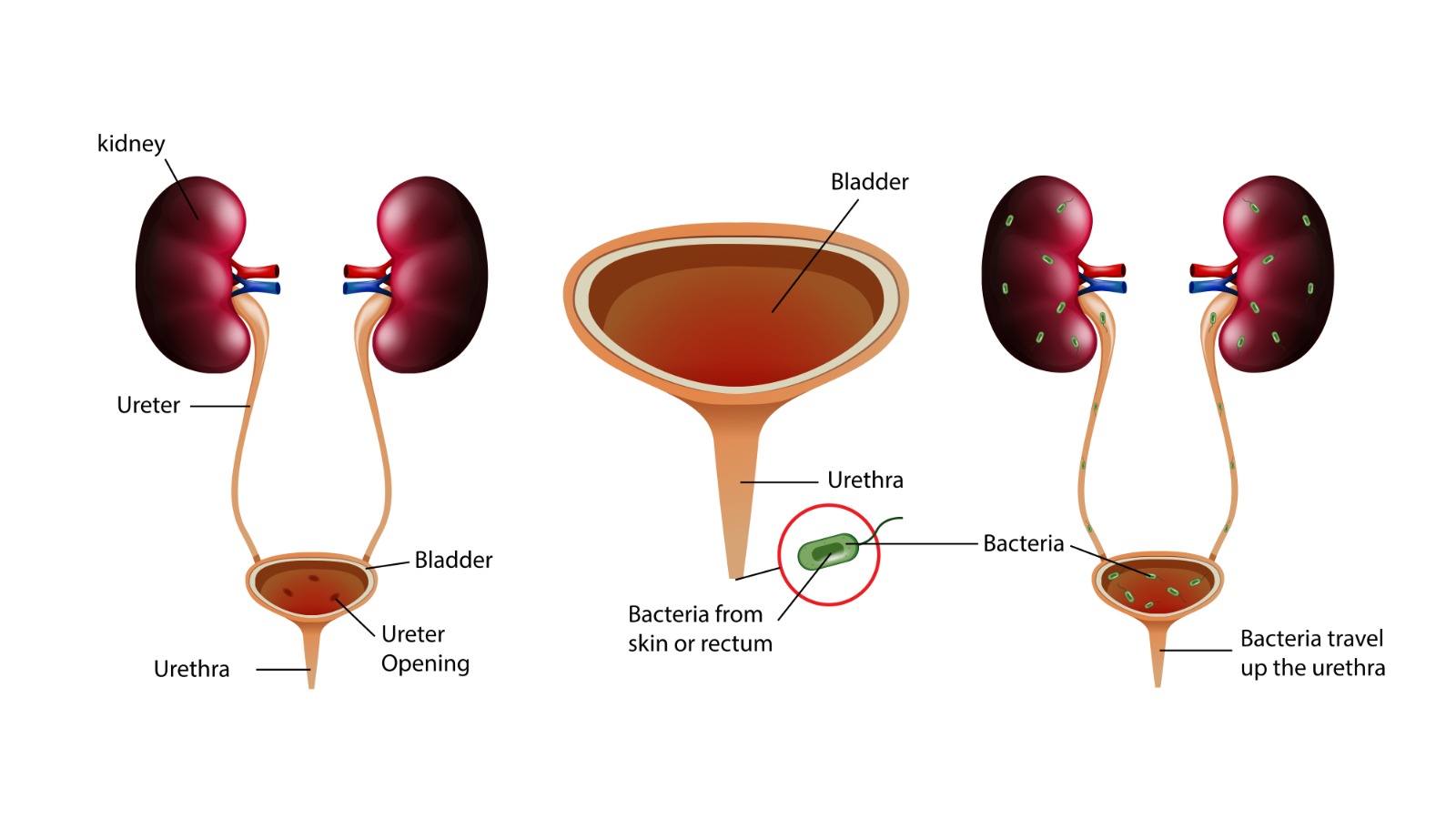 Diagrammatic Representation of UTI