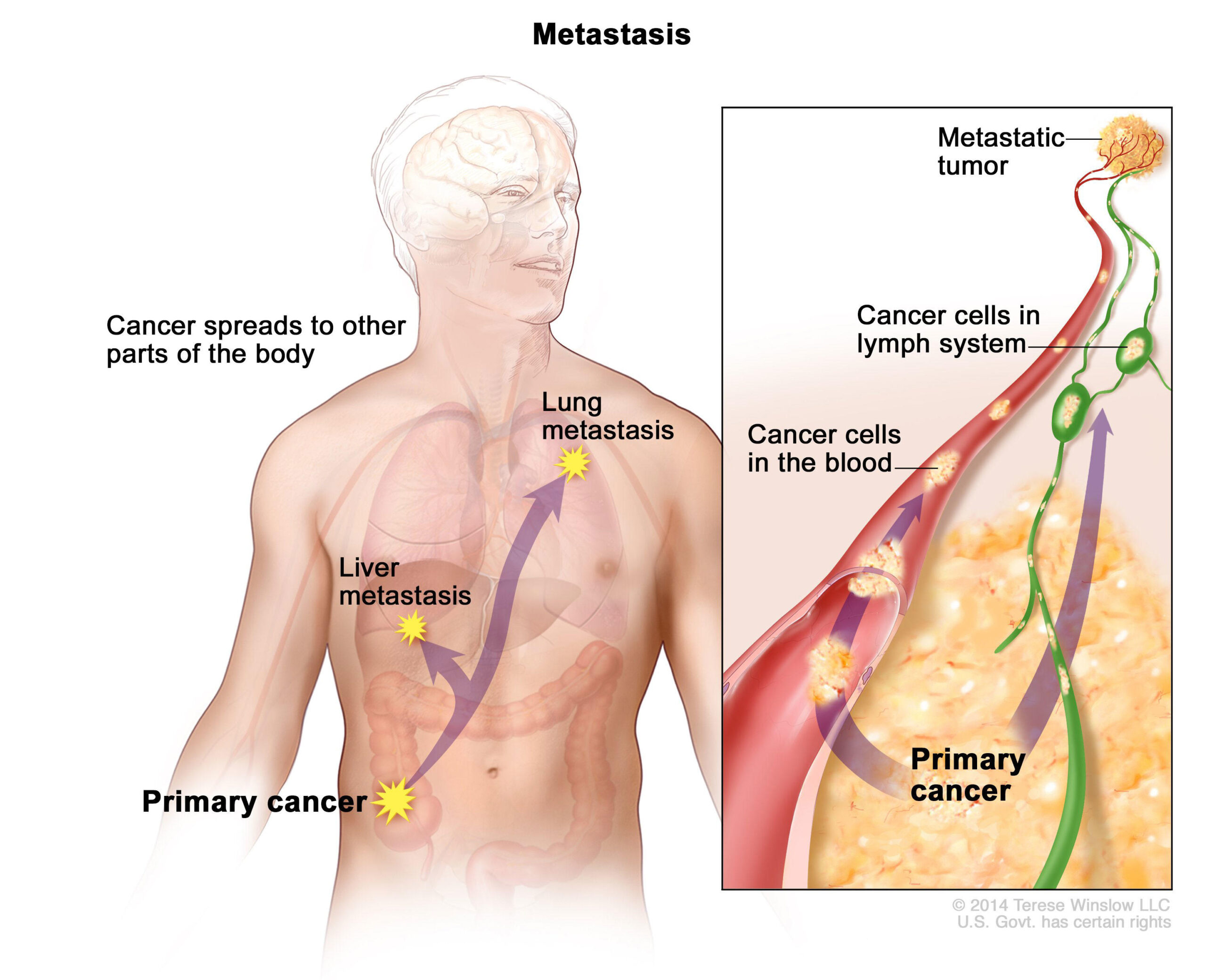 Cancer Cells: Metastasis